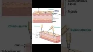 Miniature : Injection intramusculaire #etude #anatomy #médecine #injection #intramuscular_injection