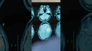 Miniature : Comment l’IA révolutionne la lutte contre le cancer
