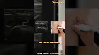 Miniature : Épaule : le repère clé du tendon du biceps | iSonicSchool