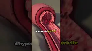 Miniature : L'hypertension est un TUEUR silencieux !