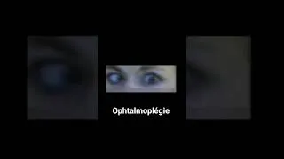 Miniature : Ophtalmoplégie