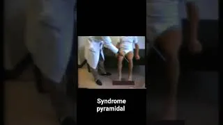 Miniature : SEP, Syndrome pyramidal