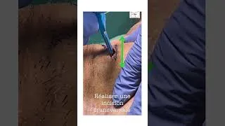 Miniature : Cricothyroïdotomie - Technique SMS