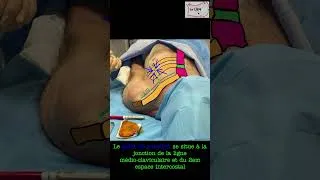 Miniature : Exsufflation d'un pneumothorax à l'aiguille