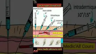 Miniature : Les 4 types d’injection #anatomie
