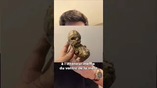 Miniature : Un bébé de pierre pendant 50 ans dans le ventre (Lithopédion) #culture #vulgarisation #santé #havox