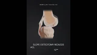 Miniature : Activmotion S - Slope change - High tibial osteotomy