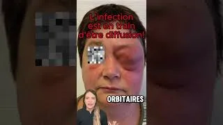 Miniature : Abcès dentaire : le danger caché jusqu’au cœur ⚠️🦷 #dentiste #dents #santébuccale