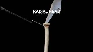 Miniature : Radial head fracture fixed by screws