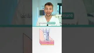 Miniature : Erreur de la pince mal fermée - Ablation d'agrafes