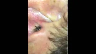 Miniature : Une araignée sort de son oreille