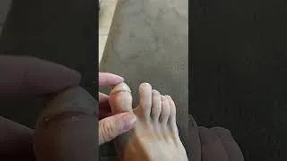 Miniature : Mon ongle se détache tout seul (10 jours après le trail de Bourbon)