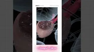 Miniature : 5 علامات صامتة لسرطان البروستات.. لا تتجاهلها!