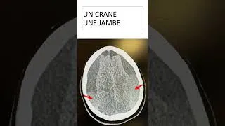 Miniature : UCA ECN - Un crane et une jambe cassée